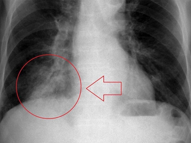 Viêm phổi có nguy hiểm không?