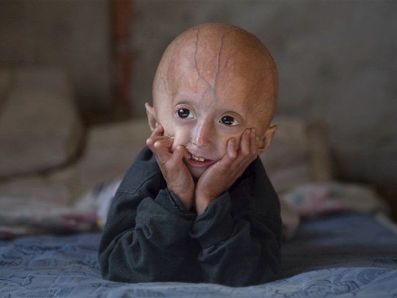 Progeria (tình trạng lão nhi) là gì?